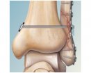 Arthrex TightRope Syndesmosis Fixation | Which Medical Device